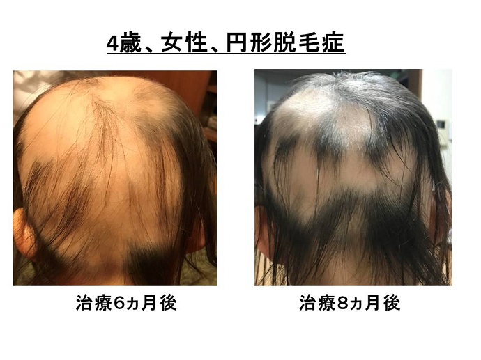 円形脱毛症　病院
